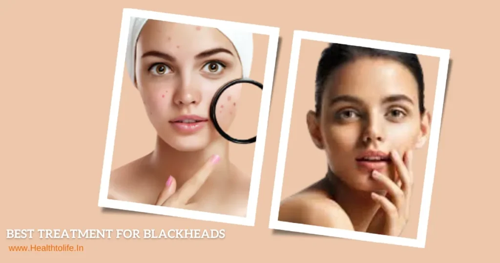 Best Treatment For Blackheads