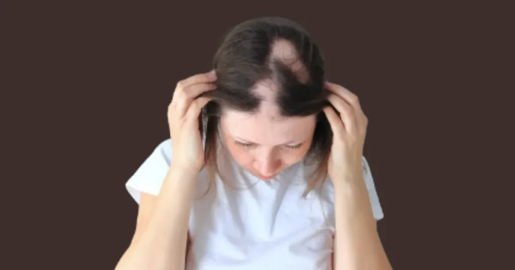 Alopecia Areata Causes And Treatment