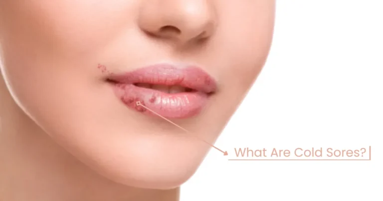 How To Cure Cold Sores On Lips