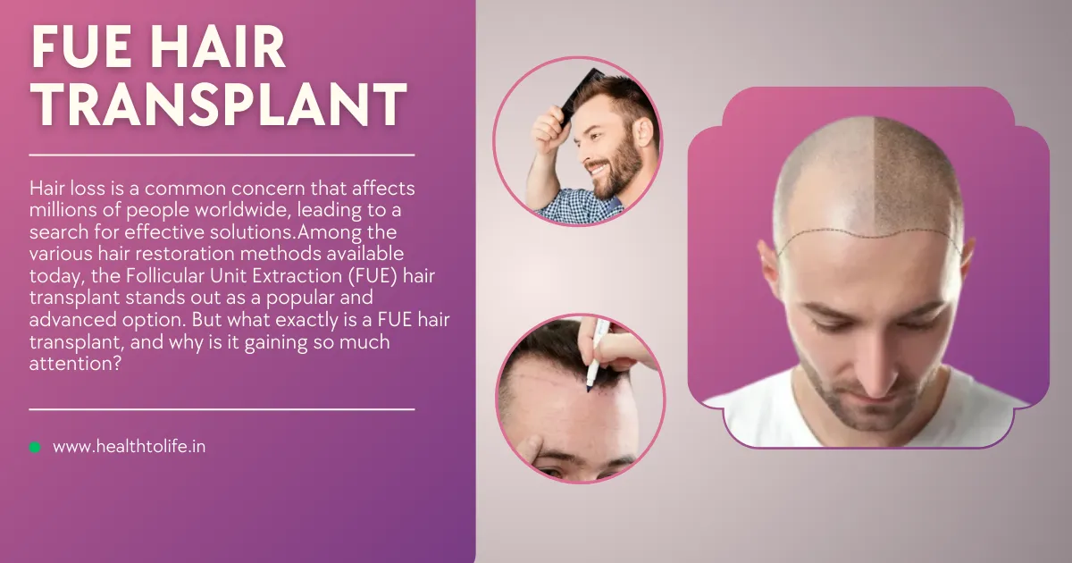 What Is A FUE Hair Transplant?