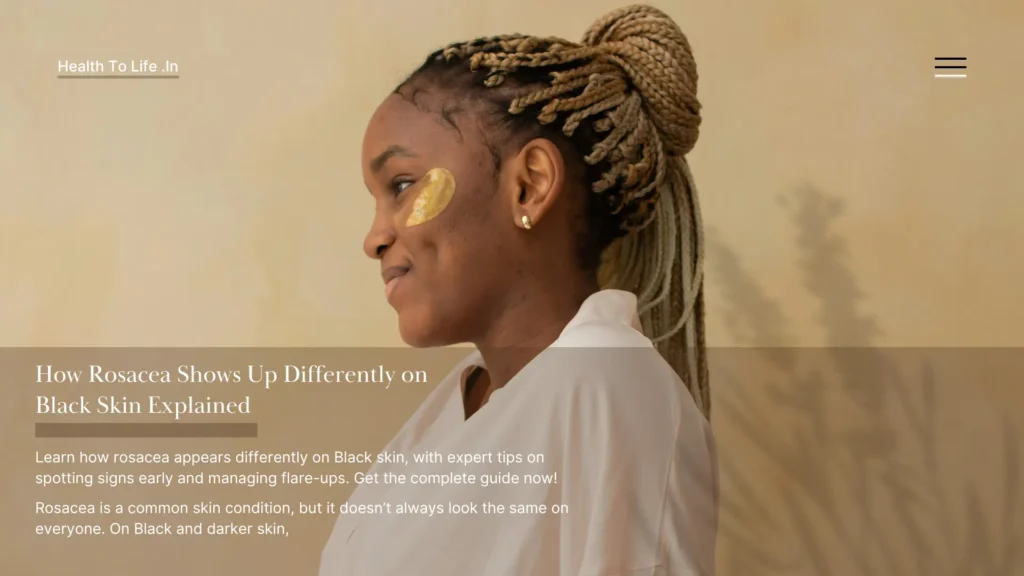 Rosacea signs on dark skin versus fair skin photo