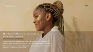 Rosacea signs on dark skin versus fair skin photo